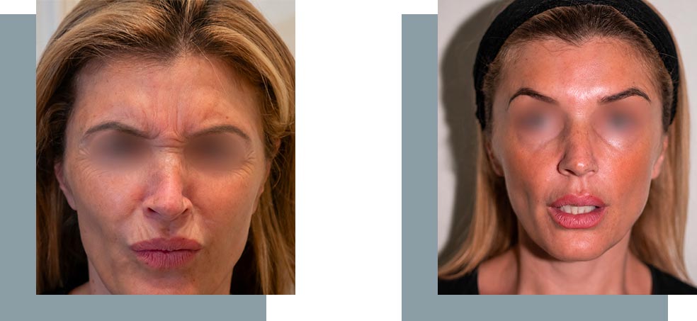 Injection de Botox à Nice