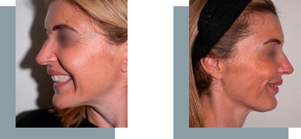 Injection de skin booster à Nice